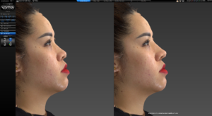 Bệnh viện thẩm mỹ Kangnam - Công nghệ mô phỏng Vectra XT 3D