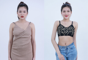 Dịch vụ giảm mỡ tại bệnh viện thẩm mỹ Kangnam