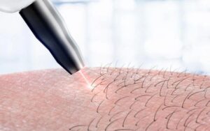 Triệt lông bằng laser 