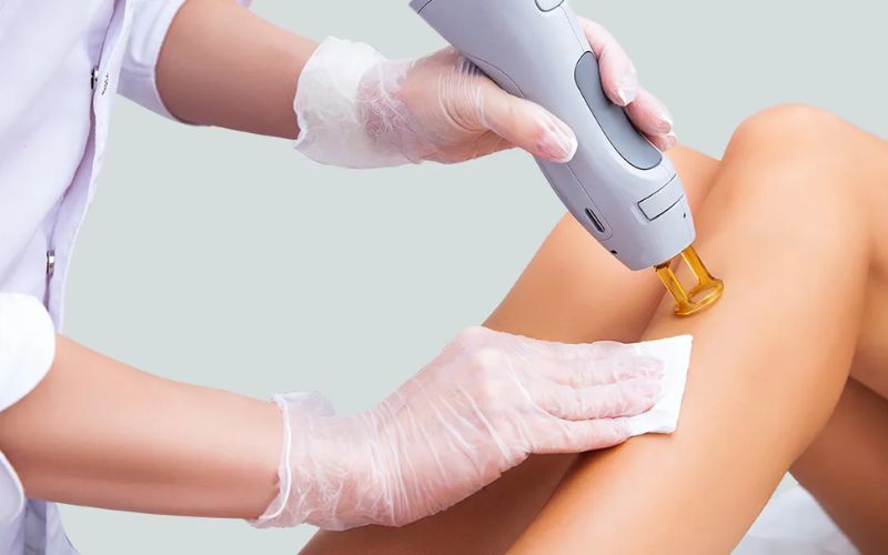 Có nên triệt lông vĩnh viễn? Bảng giá chuẩn & 5 lưu ý tránh mất tiền oan