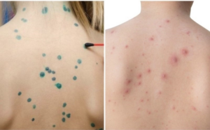 Bị thuỷ đậu kiêng gì để nhanh khỏi? Hướng dẫn chăm sóc từ A – Z