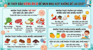 Bị thuỷ đậu kiêng gì để nhanh khỏi? Hướng dẫn chăm sóc từ A – Z