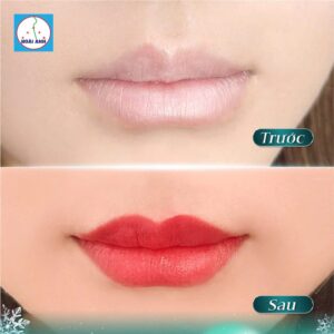 Phun môi đẹp tự nhiên tại thẩm mỹ viện Hoài Anh