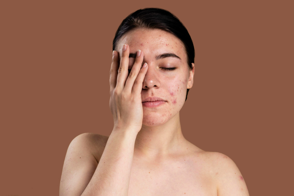 Cách làm xẹp mụn sưng đỏ sau 1 đêm hiệu quả và an toàn